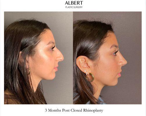 Closed (Scarless) Rhinoplasty