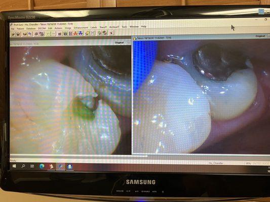 You may not want to see this and I didn't want to either... a cavity! Dr. Brandon helped me take care of it