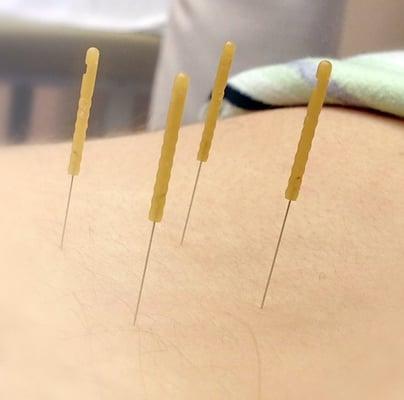 Dry Needling