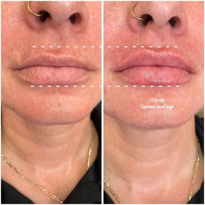 Lip injections with HA filler creating central height and symmetry.