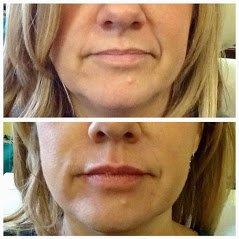 Nasal Labial filler & Lip Enhancement with Defyne & Juvederm