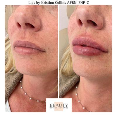 Juvederm Ultra lips to add more fullness.