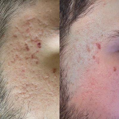 1 session microneedling results