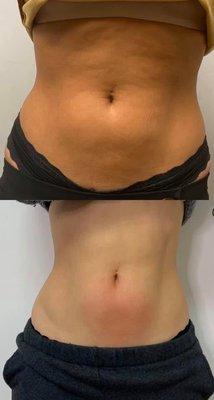 Cryoskin bodysculpting.
 Call for a special offer.