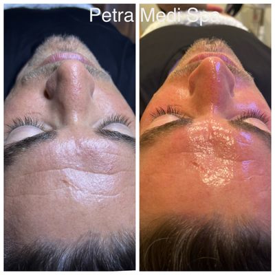 Before and after HydraFacial