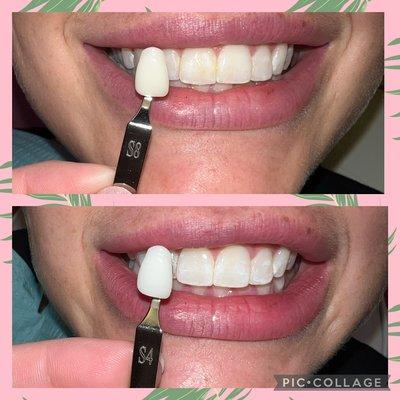 Teeth Whitening