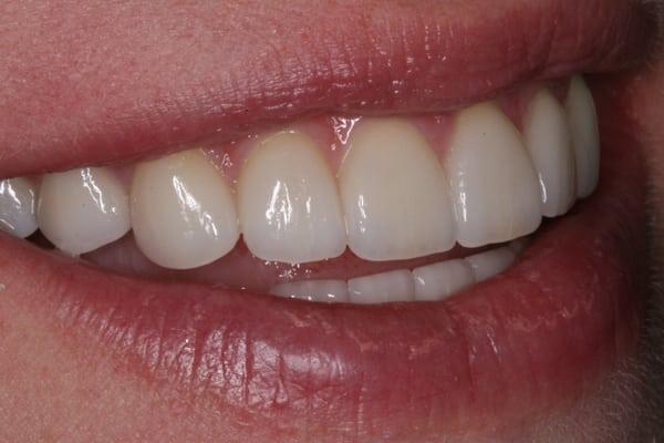 Veneers by Dr. Cantwell