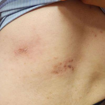 Shingles after acupuncture and Cupping treatment