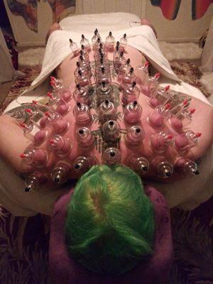 This is a cupping therapy session.   Helps reduce inflammation and reduce fatigue reliving pain and stress in muscles.