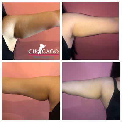 Before & After Arms Fat Cavitation