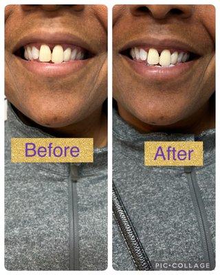 Teeth Whitening! Immediate results!