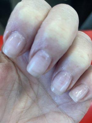 Burnt nails, cut ciuticle, uneven shape