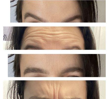 Botox before/after by Melissa H., RN