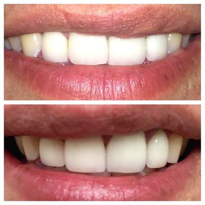 replacing a single front tooth that had a previous crown due to decay