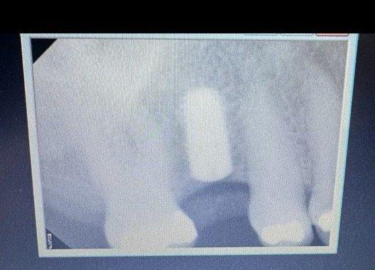 Implant was placed without complication. I was apprehensive at first, but Dr. John completely put me at ease.