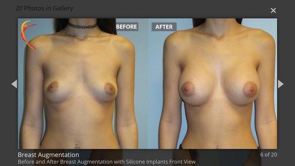 Breast Augmentation