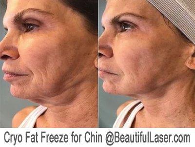 Fat Freezing Under Chin -- Better than Kybella!