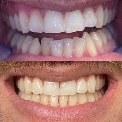 4 month Invisalign treatment