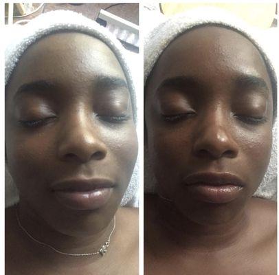 Before and After Skin Rejuvenation