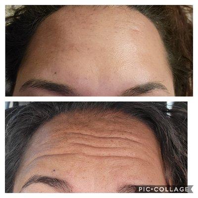 Botox before and after