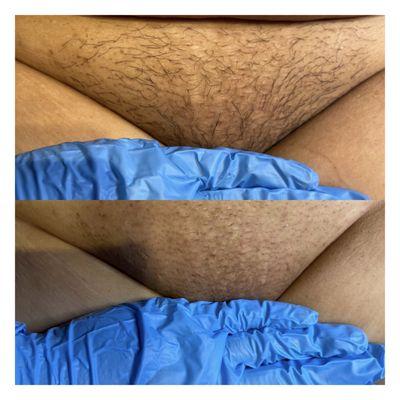 Before and after Brazilian wax