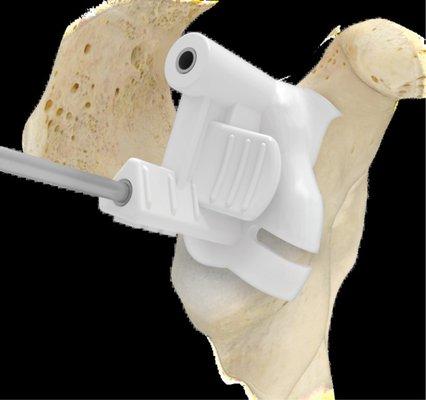 Patient specific guides improve accuracy when placing shoulder replacement components!