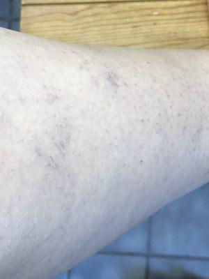 Area where catheter for ablation was inserted - blue veins and discoloration