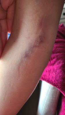 My daugher's arms after Dr. McAboy tried placing an iv 7 times and then didn't do the procedure