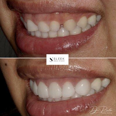 Veneers and gum reshaping