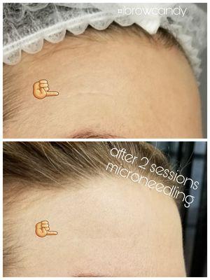 Microneedling after 2 sessions