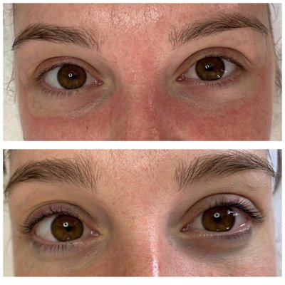 Lash lift and tint. And salicylic chemical peel