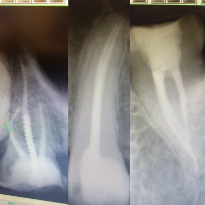 Root canals done single visit. same day appointments available.