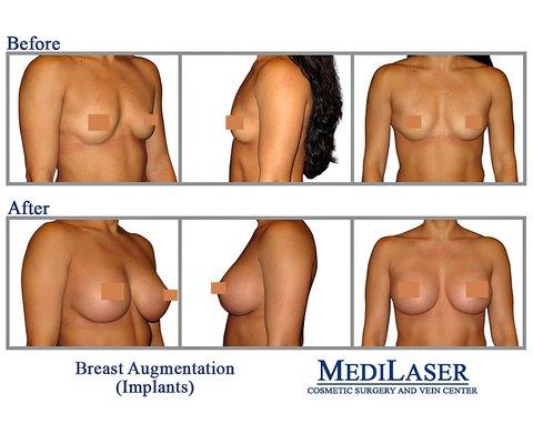 Breast-Augmentation-Cosmetic-Surgeon-The-Classic Shape-Frisco-Texas-Dr-Giraldo