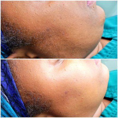 Dermaplaning before and after