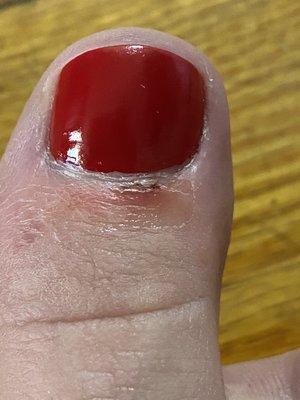 Abrasion received during pedicure