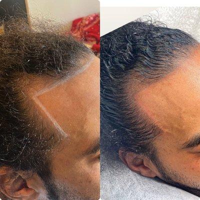 Hairline Procedure