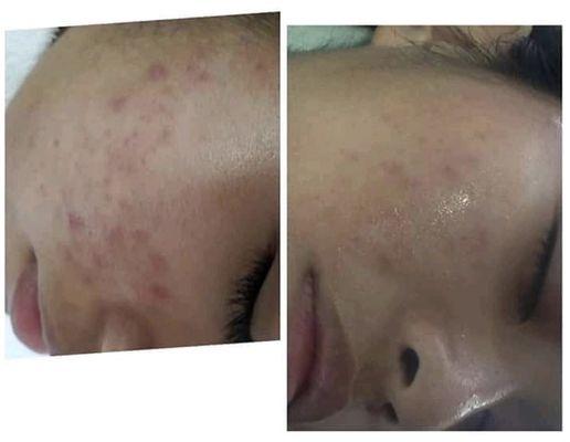 Client Kim had a series of chemical peels