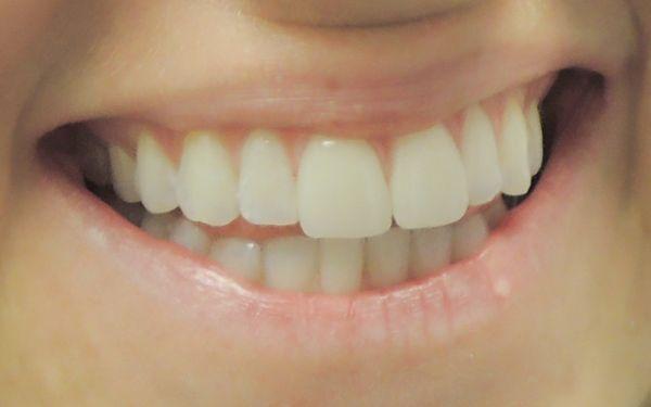 Believe it or Not, these are Porcelain Veneers, By Dr Robert Mokbel.