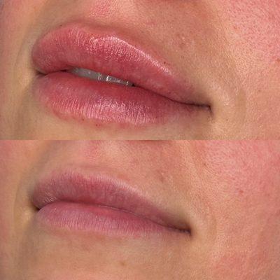 0.5 cc Lip Filler