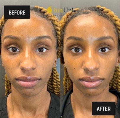 Results from VI Chemical Peel