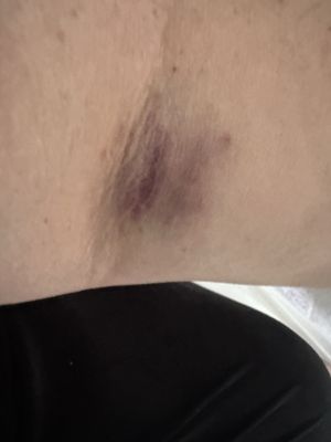 Arm bruise.