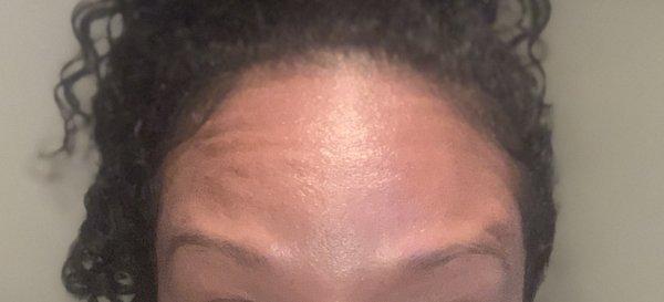 Forehead treated with Dysport only THIRTY days later