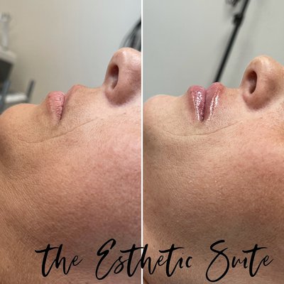 Needleless lip filler