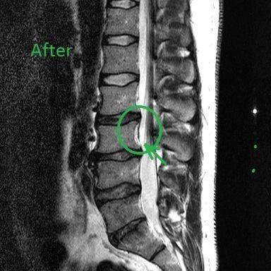 Post treatment MRI showing restoration of previously herniated lumbar disc.