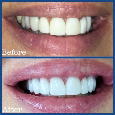 Full upper reconstruction with All Porcelain Crowns