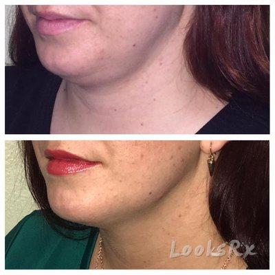 Kybella Treatment