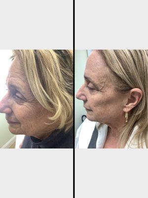 Combination treatment of Botox and fillers