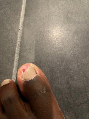 Toenail infection