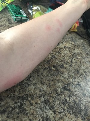 Bed bug bites from 53 Webber Street.  The Sullivan home in York Maine.