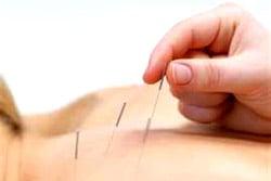 Acupuncture